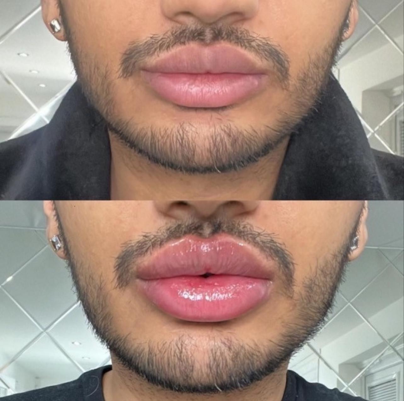 ✨ Instant Filler Lips XL – 20ml ✨Pre-Order